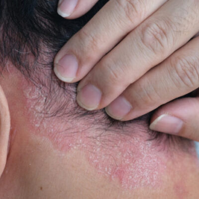 Seborrheic-dermatitis