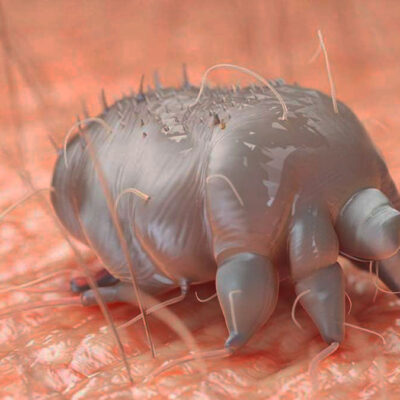 scabies-1176×662-1b