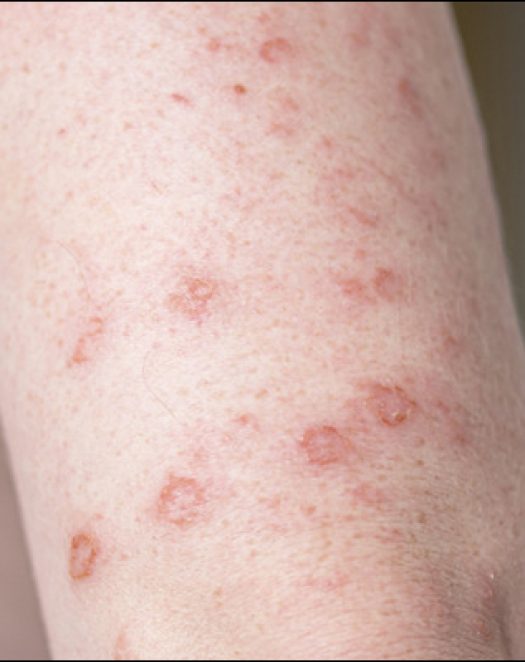Bullous-Pemphigoid Bullous-Pemphigoid