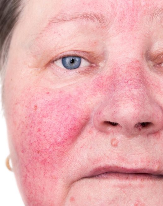Rosacea_share Rosacea_share