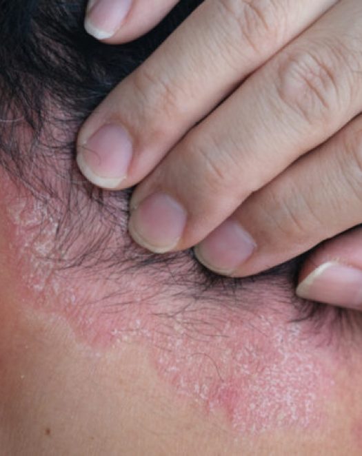 Seborrheic-dermatitis Seborrheic-dermatitis