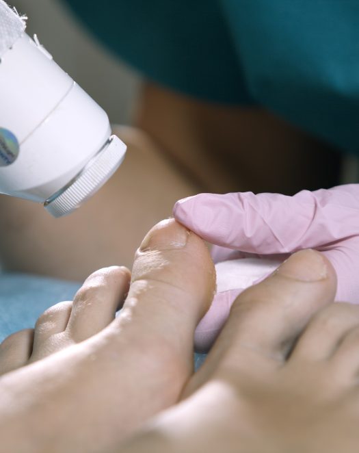 Podiatrist treating onychomycosis with a laser Podiatrist treating onychomycosis with a laser