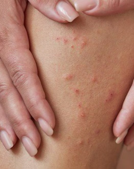 scabies-1 scabies-1