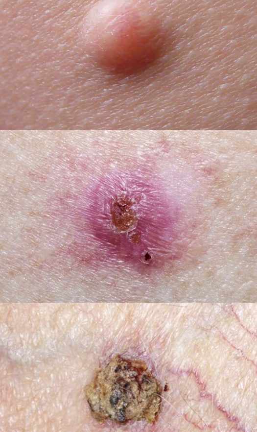 what-does-basal-cell-carcinoma-look-like